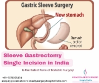 Best Price for Sleeve Gastrectomy Single Incision in India